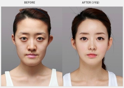 chirurgie esthétique en Corée du sud