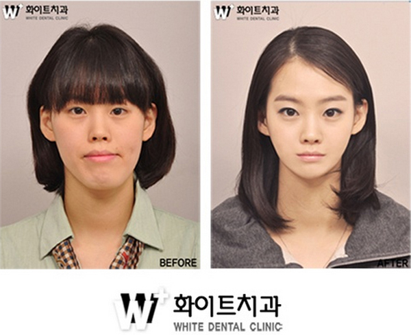 chirurgie esthétique en Corée du sud